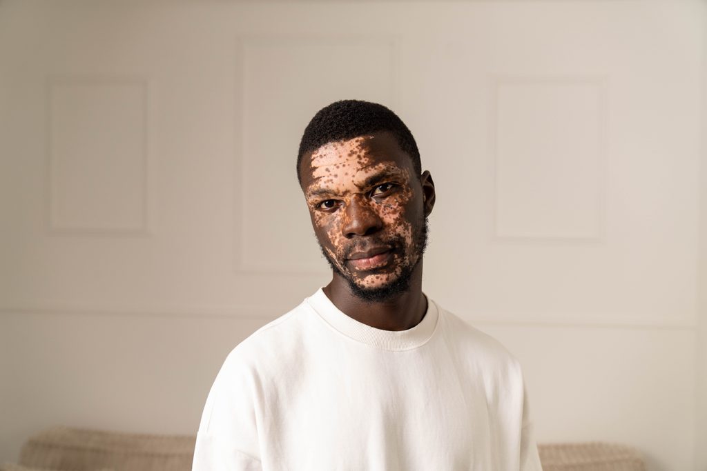 vitiligo